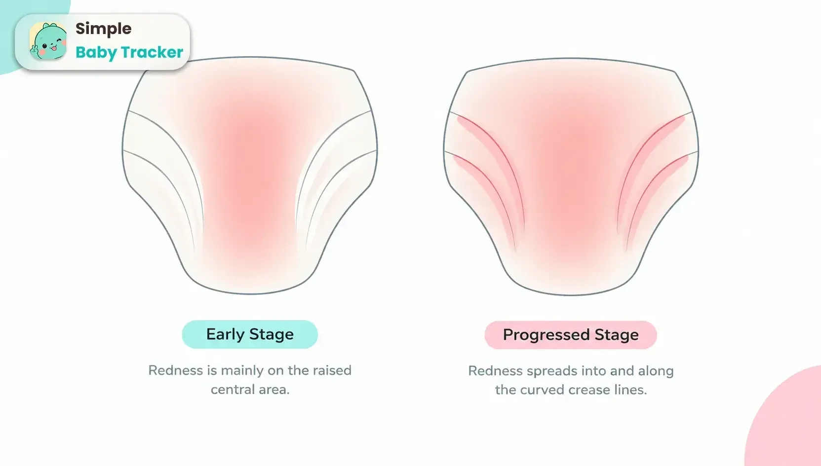 Schematic comparison of two rash patterns — one affecting only convex surfaces with folds spared, the other extending into the skin folds